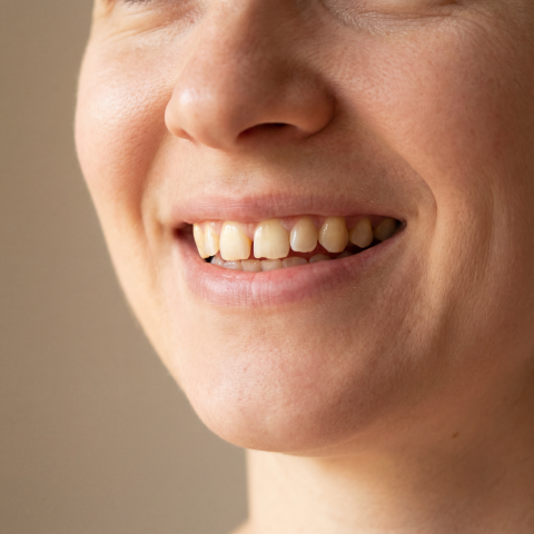 Uśmiech przed założeniem nakładki Snap-On-Smile